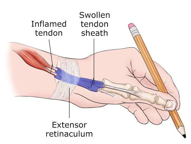De Quervain’s Tenosynovitis
