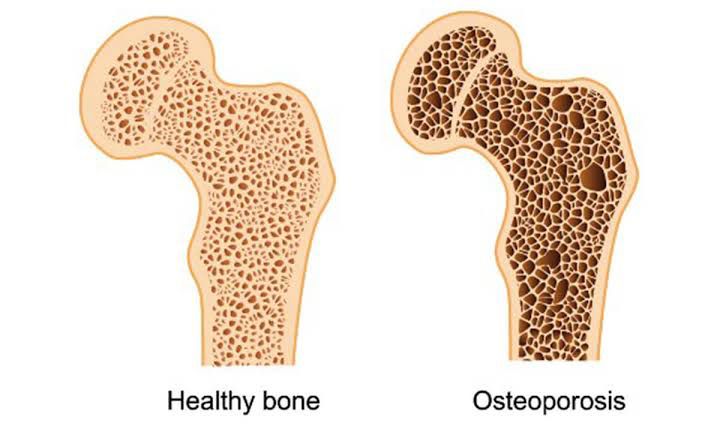 Role of Resistance Training for Bone Health