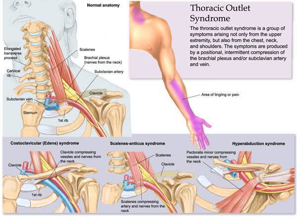 THORACIC OUTLET SYNDROME
