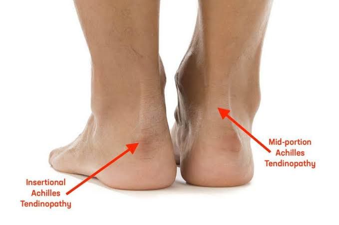 Achilles Tendinopathy