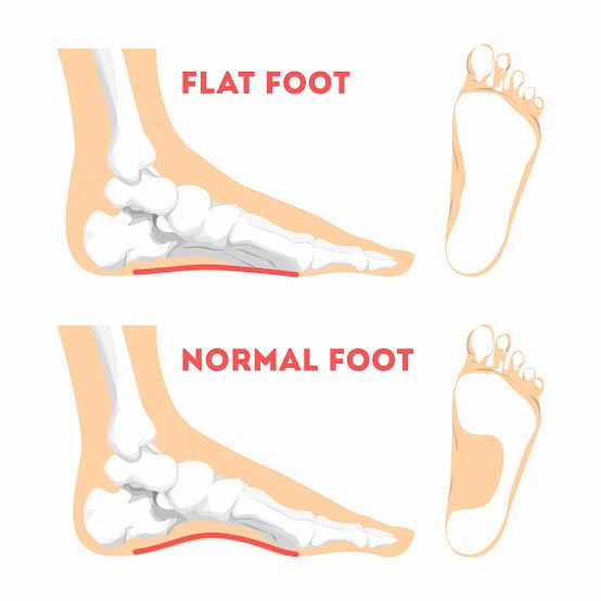Flat Feet: A Small Shift That Can Impact Your Whole Body