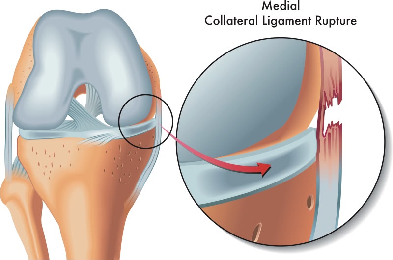 Rebuilding the Unconditioned Knee: A 3-Month Rehab Blueprint for Combined MCL and MPFL Tears
