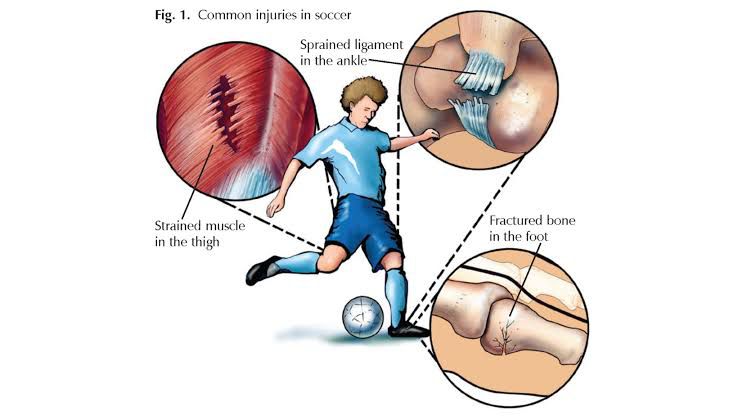 The hidden challenge: overuse injuries in youth sports.