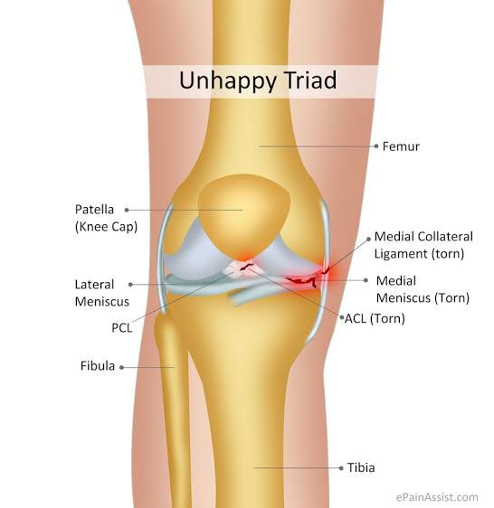 Understanding the Unhappy Triad: A Physiotherapist’s Approach