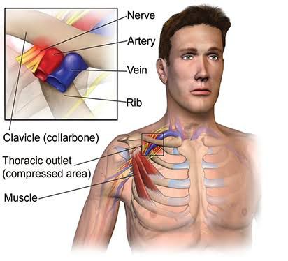THORACIC OUTLET SYNDROME