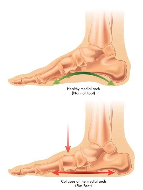 Flat Feet: A Small Shift That Can Impact Your Whole Body