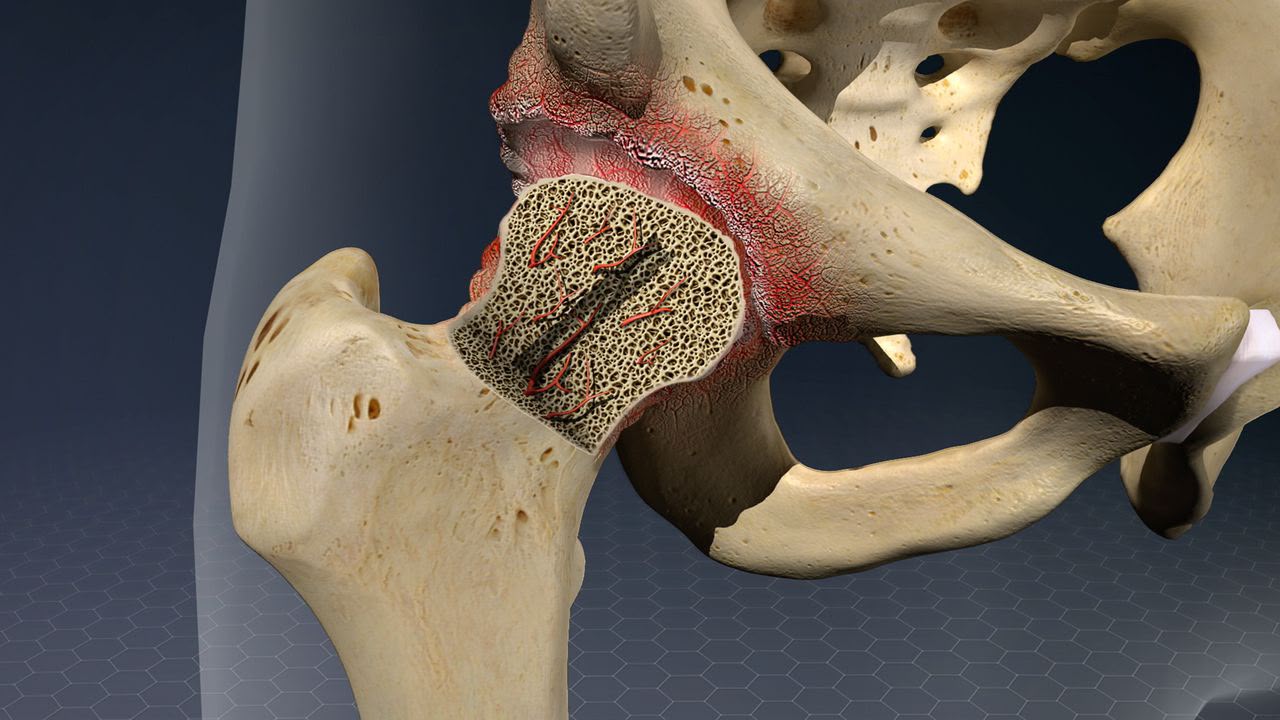 Rehabilitation Success in Bilateral Hip Avascular Necrosis (AVN)