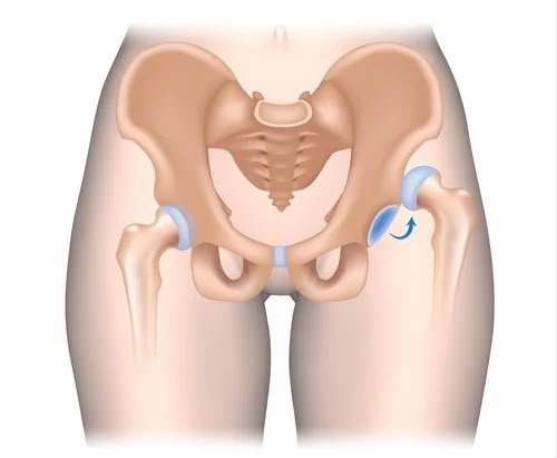 Complaining of pain in both hips