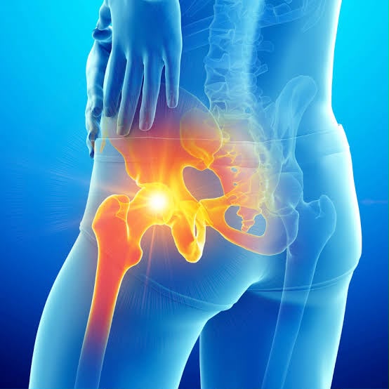     Rebuilding the Runner: How Targeted Rehabilitation Overcame Bilateral Hip OA